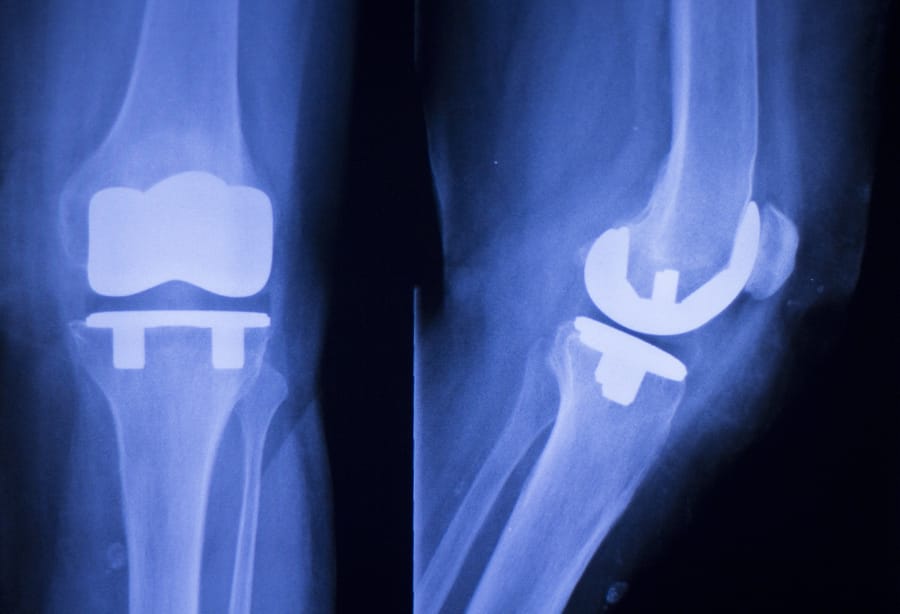 Knee Joint Implant Xray 166568522