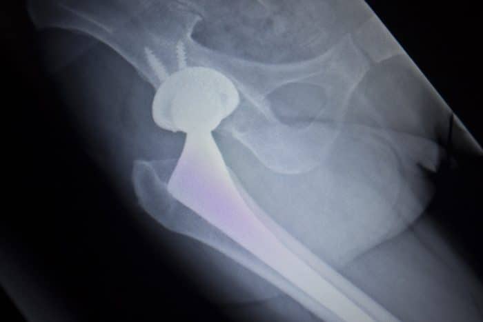 Stryker Hip Implant Lawsuit e1535737463104